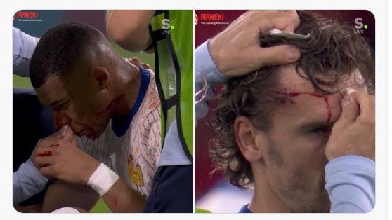 قابی از خونی شدن دو بازیکن فرانسه در اولین بازی در یورو 2024